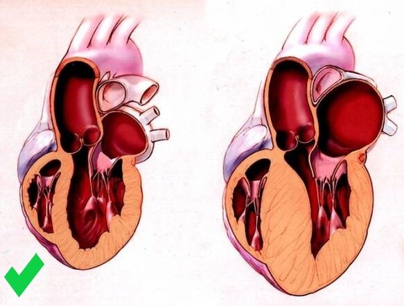 Pulsaactive previene la hipertrofia ventricular